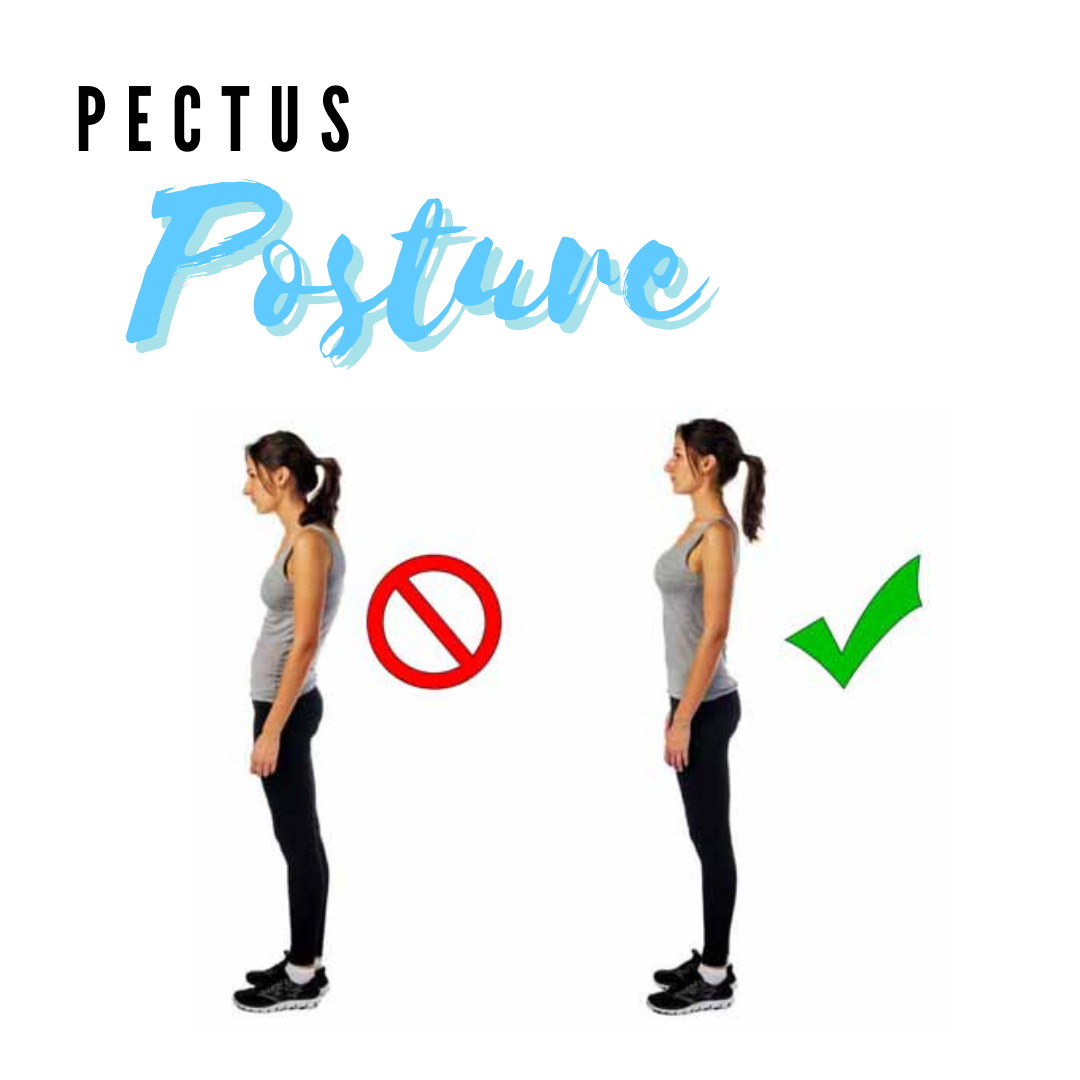 Pectus Posture: What is it?